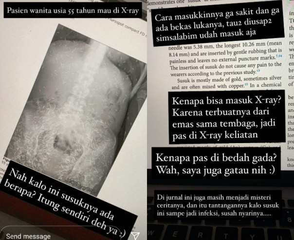 Viral Hasil X-Ray Pinggul Wanita 55 Tahun Penuh Susuk, Netizen: Satu Aja Susah Meninggalnya (foto/int)