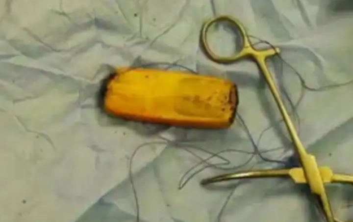 Foto : Pria Menunggu 6 Bulan Setelah Menelan Ponsel, Menjalani Operasi Setelah Mengalami Sakit