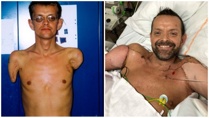 Felix sebelum dan sesudah transplantasi