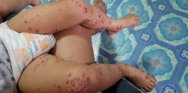 Wabah Flu Singapura gampang menular pada anak-anak (foto/int) 