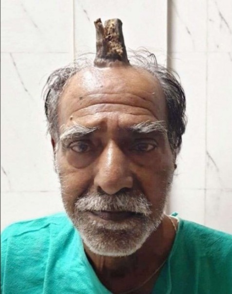Gundukan daging berbentuk tanduk yang muncul di atas kepala seorang kakek warga India. Dalam dunia kesehatan, fenomena ini disebut dengan tanduk setan. Foto: int 