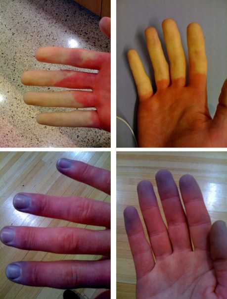 Jika Tangan Anda Mati Rasa dan Berubah Warna Saat Musim Penghujan, Penyakit Mematikan Ini yang Mengintai Anda