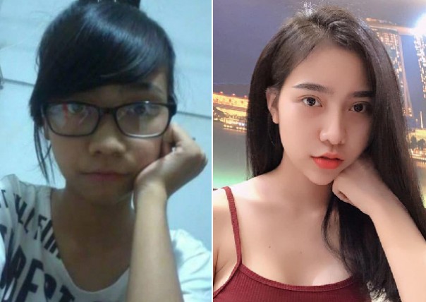 Tran Vu Van Anh sebelum dan sesudah operasi