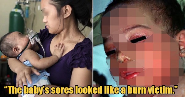 Sepasang Orang Tua Ini Tak Mau Vaksin Anaknya Karena Dianggap Haram, Bayi Malang Asal Malaysia Ini Alami Luka Bakar Mengerikan