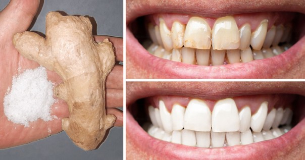 8 Cara Alami Untuk Membuat Gigi Anda Lebih Putih di Rumah