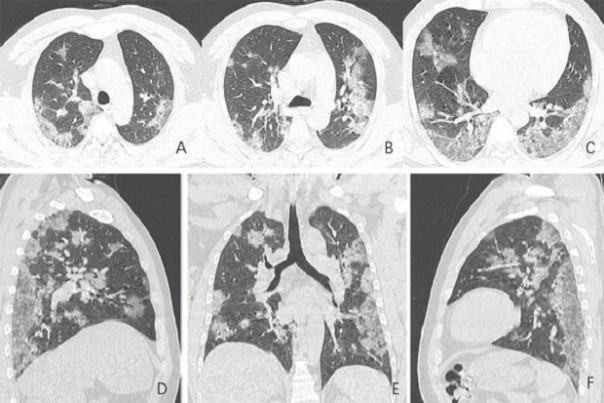 CT scan paru-paru korban virus corona