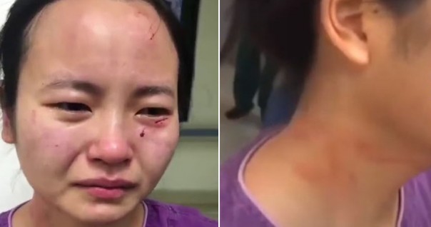 Kasihan, Perawat Cantik Ini Diserang dan Wajahnya Digigit Oleh Pasien Positif Virus Corona yang Menolak Untuk Dirawat