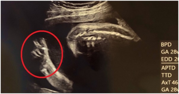 Viral, Bayi Dalam Rahim Ibu Asal Jepang Ini Menunjukkan Tanda yang Sangat Unik Saat Pemeriksaan Ultrasound