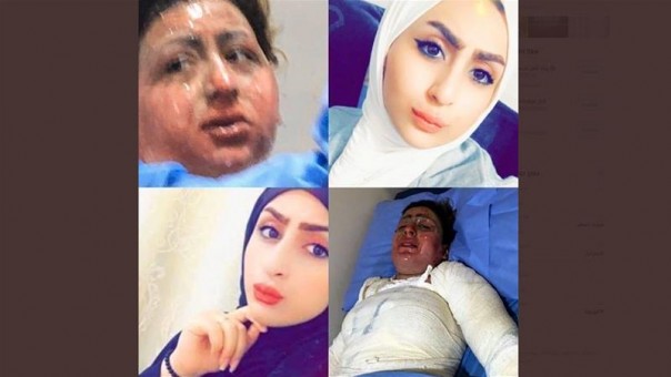 Setelah Berjuang Untuk Hidup Selama Berhari-Hari, Wanita Irak yang Disiksa dan Dibakar Oleh Suaminya Ini Meninggal Dunia