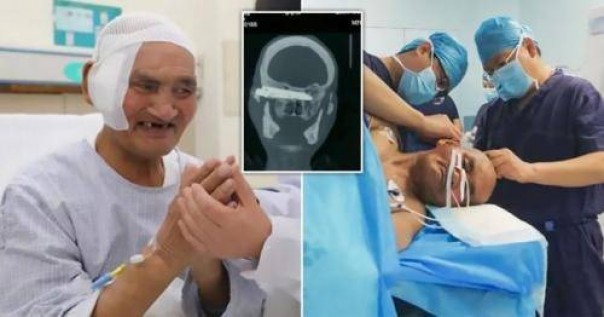 Pria di China hidup dengan kepala ditusuk pisau berkarat selama 26 tahun (foto/int)