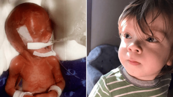 Foto-foto Menakjubkan yang Menunjukkan Bayi Saat Terlahir Dengan Berat 490 Gram Ini, Mematahkan Prediksi Dokter dan Berhasil Berjuang Untuk Hidup