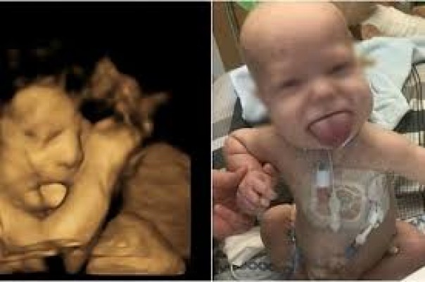 Seorang Bayi Terlahir Dengan Dua Mulut, Ini yang Dilakukan Dokter Bedah Untuk Membuatnya Normal Kembali