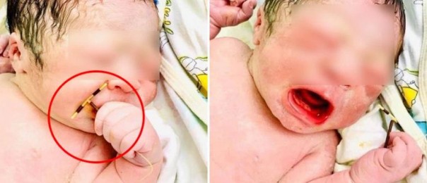 Foto Seorang Bayi Laki-Laki Memegang IUD Di Tangannya Saat Dilahirkan Jadi Viral di Sosial Media