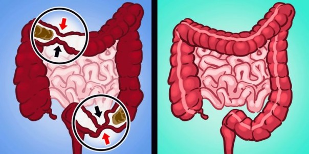 6 Cara Cepat untuk Mengakhiri Sembelit Anda