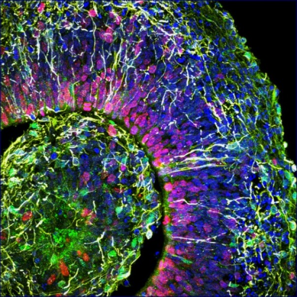 Semakin Mengerikan, Studi Mengungkapkan Jika Virus Corona Mampu Menyerang Otak 
