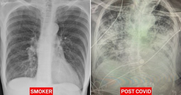 Hasil X ray Mengungkapkan Jika Paru paru Pasien  Covid  19 