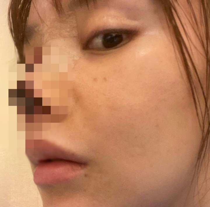 Ngeri, Hidung Aktris Ini Membusuk Usai Operasi (foto/int) 