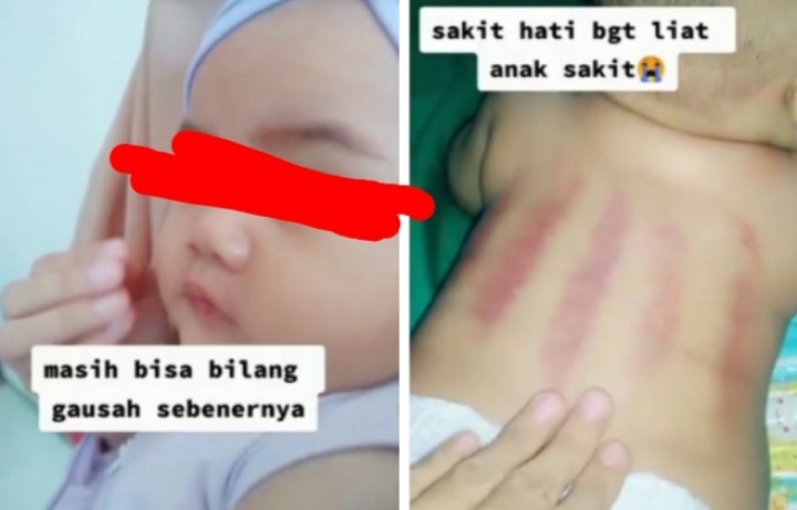 Viral Seorang Ibu Sakit Hati Anaknya Dikerok Hingga Merah, Netizen Balas Begini (foto/int) 