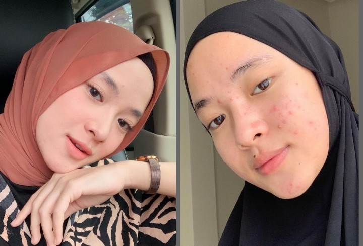 Tanpa Make Up, Nissa Sabyan Pamer Muka Berjerawat, Netizen Malah Bilang Begini (foto/int)