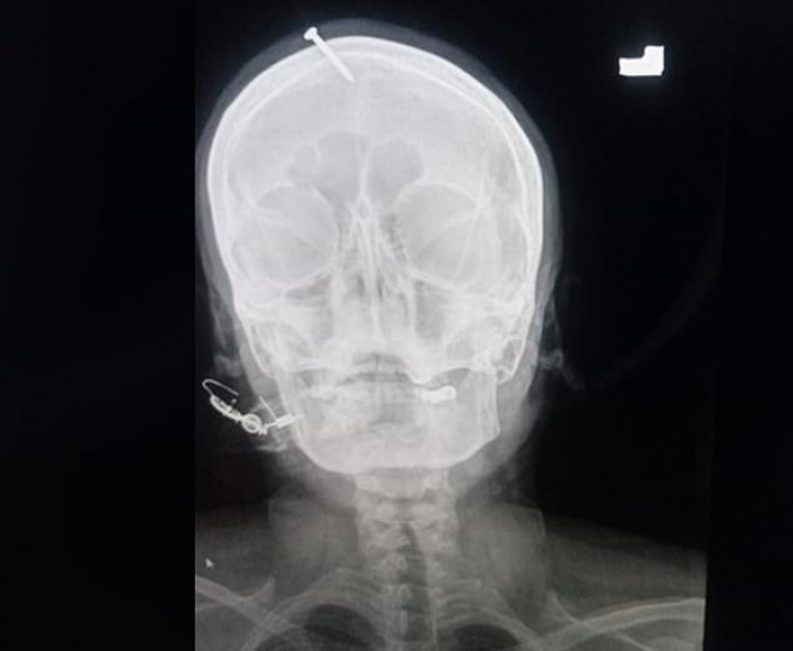 gambar x-ray si wanita