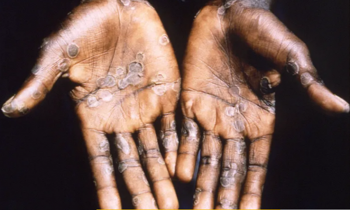 Telapak tangan pasien kasus cacar monyet dari Lodja, sebuah kota yang terletak di dalam Zona Kesehatan Katako-Kombe, terlihat selama penyelidikan kesehatan di Republik Demokratik Kongo pada tahun 1997. Gambar diambil pada tahun 1997. [File: Brian WJ Mahy/Reuters] .