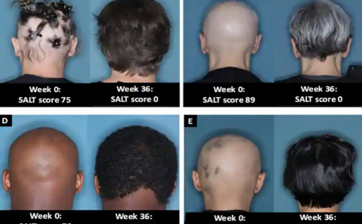 Pasien dari uji klinis, sebelum dan setelah 36 minggu pengobatan dengan baricitinib/ Dr. Brett King-Universitas Yale