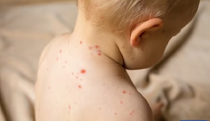 Ilustrasi Flu Tomat yang Terjadi Pada Anak (jawapos.com)
