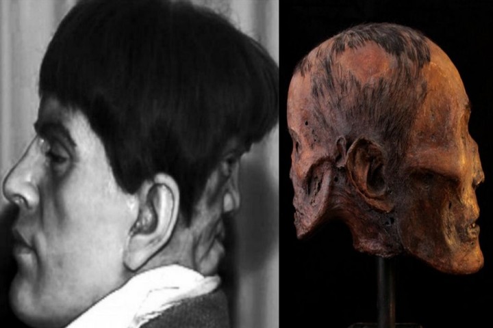 Potret Wajah dan Kerangka Edward Mordake Manusia yang memiliki dua wajah dalam satu kepala, yang terjadi pada abad ke-19 (Grid.id)