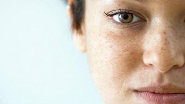Inilah 4 bahan dan cara alami untuk menghilangkan flek hitam pada wajah secara alami dan bisa dilakukan di rumah /Tribunnews.com