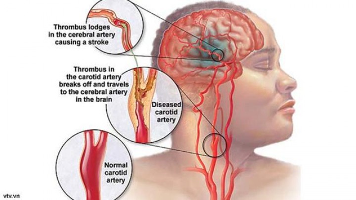 Stroke Otak: Kenali Gejalanya, Penyebab Dan Pencegahannya Dan Siapa yang Berisiko