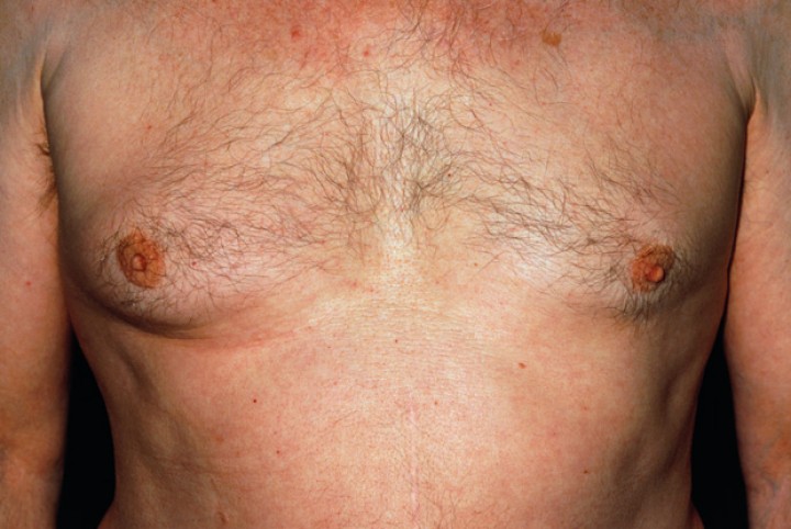 Kanker Payudara pada Pria: Ketahui Tanda-Tandanya