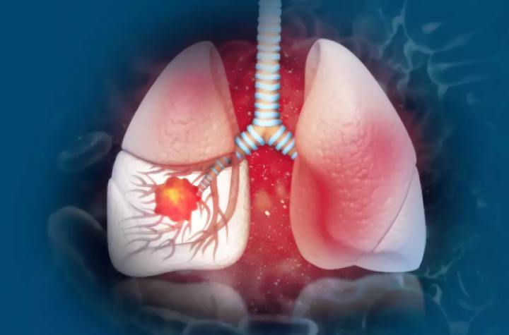 Berikut semua hal tentang kanker paru-paru /istock