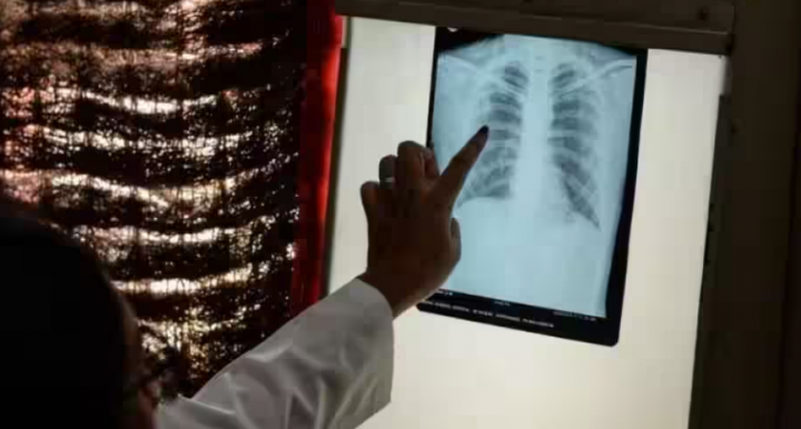 Ilustrasi gambar pasien yang terdiagnosa tuberkulosis (TB) /AFP