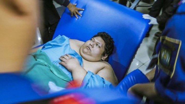 Dokter Ungkap Fajri pria Obesitas 300 Kg Sempat Alami Depresi. (CNN/Foto)