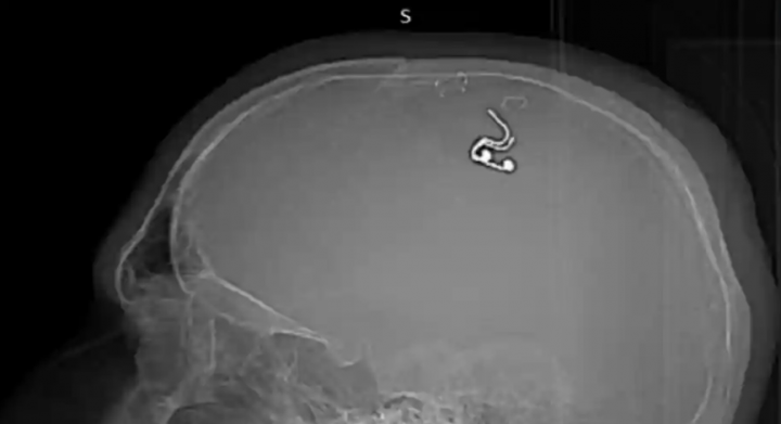X-ray menunjukkan elektroda di dalam kepala pria itu dipasang setelah pengeboran /Twitter