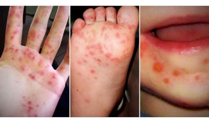 Dinas Kesehatan Temukan 22 Kasus Penyakit Mirip Gejala Flu Singapura, Hati-hati Sering Menyerang Anak-anak. (WebsiteDinasKesehatanKotaYogyakarta/Foto)