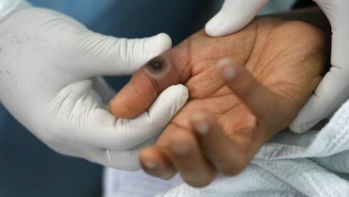 Kasus Mpox di RI Nanjak Terus, Dokter Herbal Kaji Obat Oles untuk Pasien   