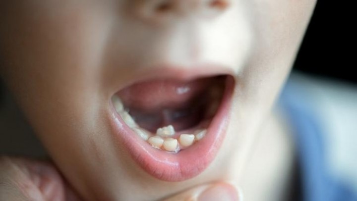 Gigi Nggak Rapi Bisa Bikin Mental Berantakan, Ini Pemicunya Menurut Dokter  