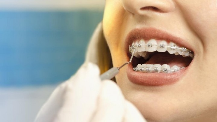 Jangan Sembarang Pasang Behel di Ahli Gigi, Dokter Ingatkan Bahayanya  