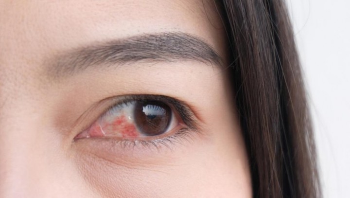 4 Penyakit Mata yang Bisa Dialami Pengidap Diabetes, Glaukoma hingga Katarak  