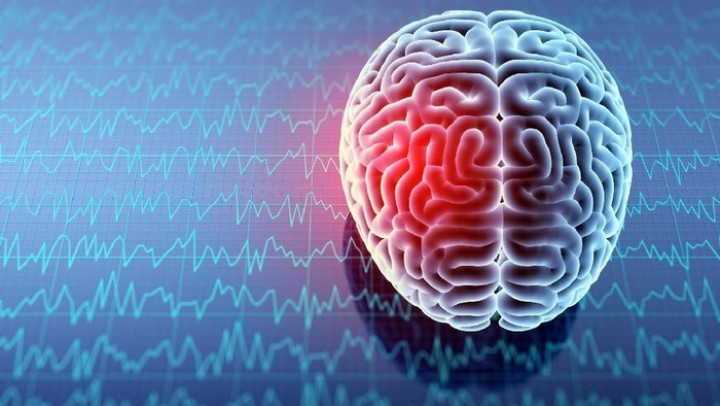 Mengenal DSA, Prosedur Deteksi Kelainan Pada Pembuluh Darah di Otak