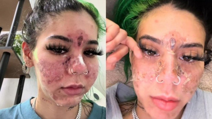 Viral Tiktoker Nekat Pakai Skincare Kedaluwarsa, Wajahnya Jadi Begini