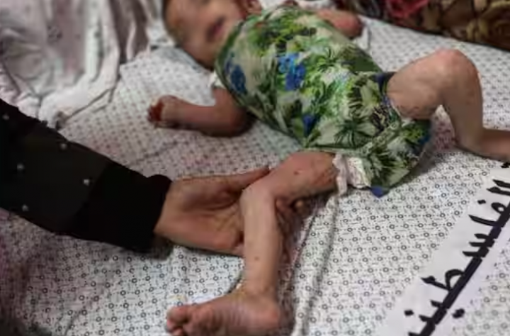 Seorang bayi perempuan Palestina yang mengalami kondisi kulit karena kekurangan gizi beristirahat di rumah sakit Kamal Adwan di Beit Lahia di Jalur Gaza utara pada 2 Juli 2024 /AFP