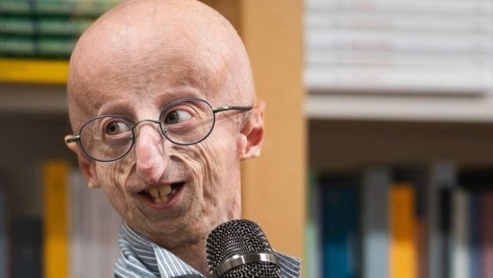 Dialami Sammy Basso, Kenali Penyakit Progeria yang Bikin Pengidapnya Tua Sejak Lahir