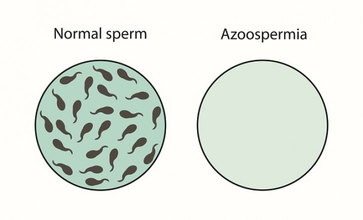 Dokter Sebut 20 Persen Pria Mandul di RI Idap Azoospermia, Kondisi Apa Itu?