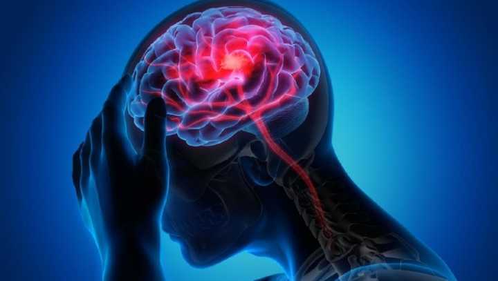 Dokter Saraf Minta Tak Anggap Sepele Kebiasaan Ini Jika Tak Ingin Terkena Stroke di Usia Muda