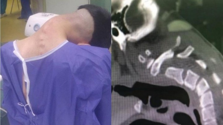Kena Sindrom Kepala Jatuh, Leher Pemuda Ini Melemah dan Bengkok