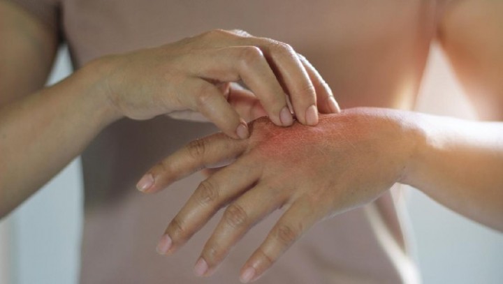 Dari Lidah Buaya hingga Kunyit, Inilah Obat Biduran Alami yang Mudah Ditemui