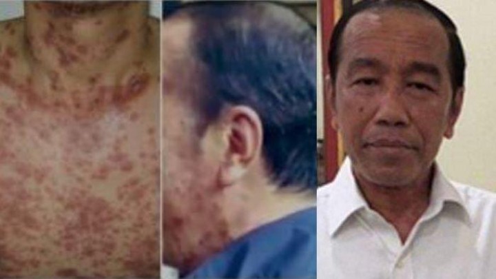 Ternyata Ini Penyebab Penyakit Kulit yang Dialami Jokowi