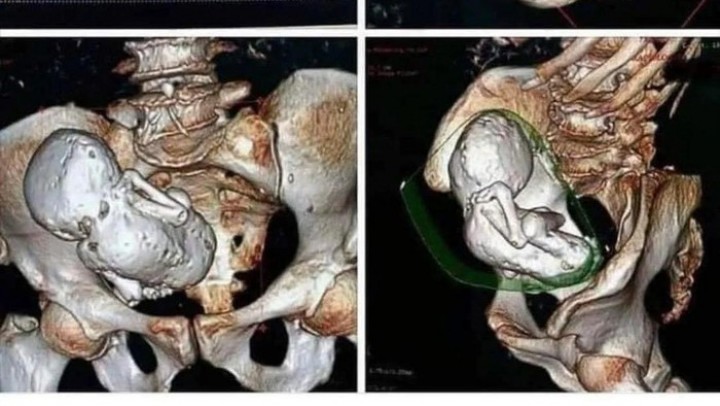 Sederet Kasus Langka Litopedion, Saat Janin Membatu dan Jadi 'Mumi' di Perut